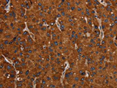 The image on the left is immunohistochemistry of paraffin-embedded Human liver cancer tissue using CSB-PA041473(SLC22A12 Antibody) at dilution 1/20, on the right is treated with synthetic peptide. (Original magnification: ×200)