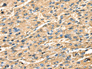 The image on the left is immunohistochemistry of paraffin-embedded Human liver cancer tissue using CSB-PA041704(STX18 Antibody) at dilution 1/25, on the right is treated with fusion protein. (Original magnification: ×200)
