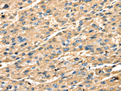 The image on the left is immunohistochemistry of paraffin-embedded Human liver cancer tissue using CSB-PA041704(STX18 Antibody) at dilution 1/25, on the right is treated with fusion protein. (Original magnification: ×200)