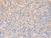 The image on the left is immunohistochemistry of paraffin-embedded Human liver cancer tissue using CSB-PA041746(STK16 Antibody) at dilution 1/25, on the right is treated with fusion protein. (Original magnification: ×200)