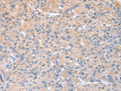 The image on the left is immunohistochemistry of paraffin-embedded Human liver cancer tissue using CSB-PA041746(STK16 Antibody) at dilution 1/25, on the right is treated with fusion protein. (Original magnification: ×200)