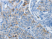 The image on the left is immunohistochemistry of paraffin-embedded Human liver cancer tissue using CSB-PA041842(PRKG2 Antibody) at dilution 1/20, on the right is treated with synthetic peptide. (Original magnification: ×200)