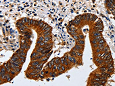 The image on the left is immunohistochemistry of paraffin-embedded Human colon cancer tissue using CSB-PA041845(KRT23 Antibody) at dilution 1/20, on the right is treated with fusion protein. (Original magnification: ×200)