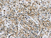 The image on the left is immunohistochemistry of paraffin-embedded Human prostate cancer tissue using CSB-PA042084(USP28 Antibody) at dilution 1/35, on the right is treated with synthetic peptide. (Original magnification: ×200)