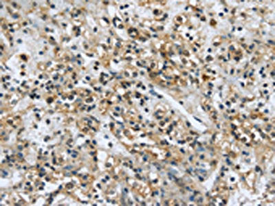 The image on the left is immunohistochemistry of paraffin-embedded Human prostate cancer tissue using CSB-PA042084(USP28 Antibody) at dilution 1/35, on the right is treated with synthetic peptide. (Original magnification: ×200)