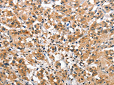 The image on the left is immunohistochemistry of paraffin-embedded Human thyroid cancer tissue using CSB-PA042170(SMAD1 Antibody) at dilution 1/40, on the right is treated with synthetic peptide. (Original magnification: ×200)