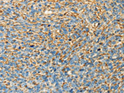The image on the left is immunohistochemistry of paraffin-embedded Human ovarian cancer tissue using CSB-PA042329(APOA4 Antibody) at dilution 1/30, on the right is treated with fusion protein. (Original magnification: ×200)