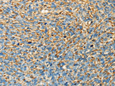 The image on the left is immunohistochemistry of paraffin-embedded Human ovarian cancer tissue using CSB-PA042329(APOA4 Antibody) at dilution 1/30, on the right is treated with fusion protein. (Original magnification: ×200)