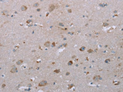 The image on the left is immunohistochemistry of paraffin-embedded Human brain tissue using CSB-PA042400(LIMK1 Antibody) at dilution 1/25, on the right is treated with synthetic peptide. (Original magnification: ×200)