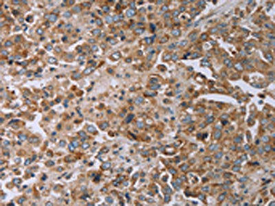 The image on the left is immunohistochemistry of paraffin-embedded Human liver cancer tissue using CSB-PA042633(TNPO1 Antibody) at dilution 1/20, on the right is treated with synthetic peptide. (Original magnification: ×200)