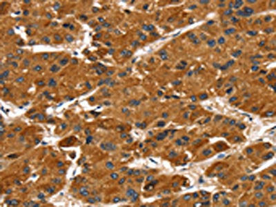 The image on the left is immunohistochemistry of paraffin-embedded Human liver cancer tissue using CSB-PA043015(PTPN5 Antibody) at dilution 1/30, on the right is treated with fusion protein. (Original magnification: ×200)
