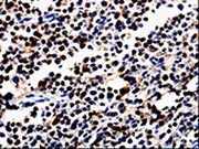 The image is immunohistochemistry of paraffin-embedded Human colon cancer tissue using CSB-PA043268(ALOX5 Antibody) at dilution 1/50. (Original magnification: ×200)