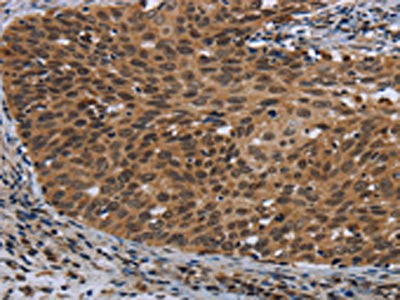 The image on the left is immunohistochemistry of paraffin-embedded Human cervical cancer tissue using CSB-PA043289(CEBPD Antibody) at dilution 1/40, on the right is treated with synthetic peptide. (Original magnification: ×200)