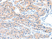 The image on the left is immunohistochemistry of paraffin-embedded Human lung cancer tissue using CSB-PA043425(ADAM32 Antibody) at dilution 1/15, on the right is treated with fusion protein. (Original magnification: ×200)