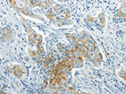 The image on the left is immunohistochemistry of paraffin-embedded Human cervical cancer tissue using CSB-PA043432(WNT8B Antibody) at dilution 1/20, on the right is treated with synthetic peptide. (Original magnification: ×200)