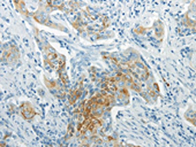 The image on the left is immunohistochemistry of paraffin-embedded Human cervical cancer tissue using CSB-PA043432(WNT8B Antibody) at dilution 1/20, on the right is treated with synthetic peptide. (Original magnification: ×200)