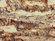 IHC image of CSB-PA04355A0Rb diluted at 1:1200 and staining in paraffin-embedded human colon cancer performed on a Leica BondTM system. After dewaxing and hydration, antigen retrieval was mediated by high pressure in a citrate buffer (pH 6.0). Sec...