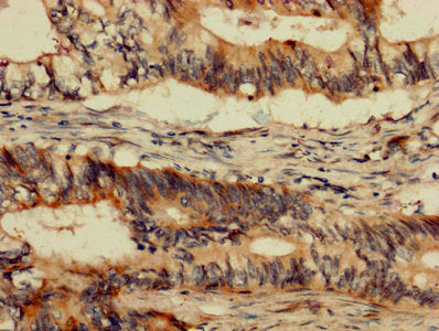 IHC image of CSB-PA04355A0Rb diluted at 1:1200 and staining in paraffin-embedded human colon cancer performed on a Leica BondTM system. After dewaxing and hydration, antigen retrieval was mediated by high pressure in a citrate buffer (pH 6.0). Sec...