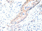 The image on the left is immunohistochemistry of paraffin-embedded Human colon cancer tissue using CSB-PA043583(ACAD10 Antibody) at dilution 1/15, on the right is treated with fusion protein. (Original magnification: ×200)