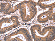 The image on the left is immunohistochemistry of paraffin-embedded Human colon cancer tissue using CSB-PA043697(CRK Antibody) at dilution 1/50, on the right is treated with fusion protein. (Original magnification: ×200)