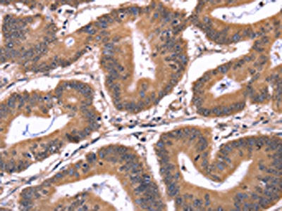 The image on the left is immunohistochemistry of paraffin-embedded Human colon cancer tissue using CSB-PA043697(CRK Antibody) at dilution 1/50, on the right is treated with fusion protein. (Original magnification: ×200)