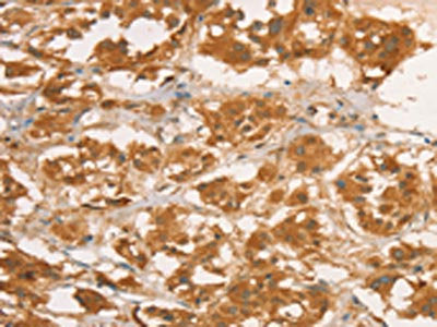 The image on the left is immunohistochemistry of paraffin-embedded Human thyroid cancer tissue using CSB-PA043712(CPB1 Antibody) at dilution 1/50, on the right is treated with fusion protein. (Original magnification: ×200)