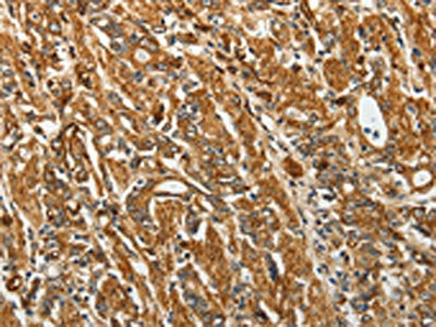 The image on the left is immunohistochemistry of paraffin-embedded Human gastic cancer tissue using CSB-PA043719(RPLP0 Antibody) at dilution 1/40, on the right is treated with fusion protein. (Original magnification: ×200)