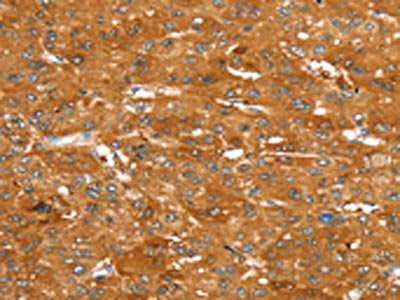 The image on the left is immunohistochemistry of paraffin-embedded Human liver cancer tissue using CSB-PA043862(ABCC9 Antibody) at dilution 1/50, on the right is treated with synthetic peptide. (Original magnification: ×200)