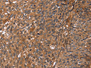 The image on the left is immunohistochemistry of paraffin-embedded Human cervical cancer tissue using CSB-PA043863(APAF1 Antibody) at dilution 1/40, on the right is treated with synthetic peptide. (Original magnification: ×200)