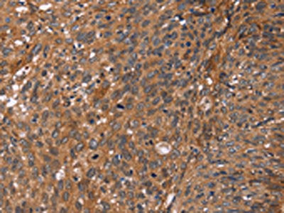 The image on the left is immunohistochemistry of paraffin-embedded Human cervical cancer tissue using CSB-PA043863(APAF1 Antibody) at dilution 1/40, on the right is treated with synthetic peptide. (Original magnification: ×200)