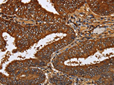 The image on the left is immunohistochemistry of paraffin-embedded Human colon cancer tissue using CSB-PA043920(TICAM2 Antibody) at dilution 1/60, on the right is treated with fusion protein. (Original magnification: ×200)