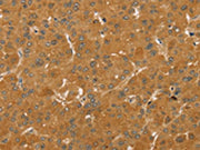 The image on the left is immunohistochemistry of paraffin-embedded Human liver cancer tissue using CSB-PA044096(TAF11 Antibody) at dilution 1/25, on the right is treated with fusion protein. (Original magnification: ×200)
