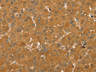 The image on the left is immunohistochemistry of paraffin-embedded Human liver cancer tissue using CSB-PA044096(TAF11 Antibody) at dilution 1/25, on the right is treated with fusion protein. (Original magnification: ×200)
