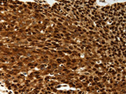 The image on the left is immunohistochemistry of paraffin-embedded Human cervical cancer tissue using CSB-PA044197(SCN1A Antibody) at dilution 1/50, on the right is treated with synthetic peptide. (Original magnification: ×200)