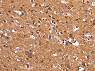 The image on the left is immunohistochemistry of paraffin-embedded Human brain tissue using CSB-PA044365(HSD17B1 Antibody) at dilution 1/40, on the right is treated with synthetic peptide. (Original magnification: ×200)