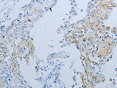 The image on the left is immunohistochemistry of paraffin-embedded Human cervical cancer tissue using CSB-PA044408(JUP Antibody) at dilution 1/25, on the right is treated with synthetic peptide. (Original magnification: ×200)