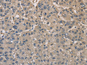The image on the left is immunohistochemistry of paraffin-embedded Human liver cancer tissue using CSB-PA044503(DPYSL3 Antibody) at dilution 1/20, on the right is treated with fusion protein. (Original magnification: ×200)