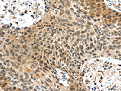 The image on the left is immunohistochemistry of paraffin-embedded Human brain tissue using CSB-PA044546(PLIN3 Antibody) at dilution 1/40, on the right is treated with synthetic peptide. (Original magnification: ×200)
