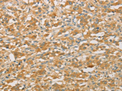 The image on the left is immunohistochemistry of paraffin-embedded Human thyroid cancer tissue using CSB-PA044730(PRPSAP1 Antibody) at dilution 1/50, on the right is treated with fusion protein. (Original magnification: ×200)