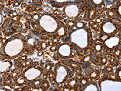 The image on the left is immunohistochemistry of paraffin-embedded Human thyroid cancer tissue using CSB-PA044833(SSBP1 Antibody) at dilution 1/20, on the right is treated with fusion protein. (Original magnification: ×200)