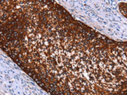 The image on the left is immunohistochemistry of paraffin-embedded Human cervical cancer tissue using CSB-PA045049(HMGCS2 Antibody) at dilution 1/40, on the right is treated with synthetic peptide. (Original magnification: ×200)