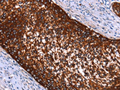 The image on the left is immunohistochemistry of paraffin-embedded Human cervical cancer tissue using CSB-PA045049(HMGCS2 Antibody) at dilution 1/40, on the right is treated with synthetic peptide. (Original magnification: ×200)