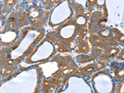 The image on the left is immunohistochemistry of paraffin-embedded Human thyroid cancer tissue using CSB-PA045108(SNX5 Antibody) at dilution 1/25, on the right is treated with synthetic peptide. (Original magnification: ×200)