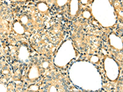 The image on the left is immunohistochemistry of paraffin-embedded Human thyroid cancer tissue using CSB-PA045438(DNASE1 Antibody) at dilution 1/20, on the right is treated with fusion protein. (Original magnification: ×200)