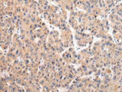 The image on the left is immunohistochemistry of paraffin-embedded Human liver cancer tissue using CSB-PA045692(USP47 Antibody) at dilution 1/20, on the right is treated with fusion protein. (Original magnification: ×200)