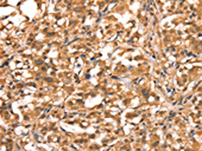 The image on the left is immunohistochemistry of paraffin-embedded Human thyroid cancer tissue using CSB-PA045809(ACADVL Antibody) at dilution 1/15, on the right is treated with synthetic peptide. (Original magnification: ×200)