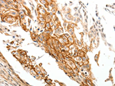The image on the left is immunohistochemistry of paraffin-embedded Human cervical cancer tissue using CSB-PA045896(TGM1 Antibody) at dilution 1/25, on the right is treated with synthetic peptide. (Original magnification: ×200)