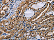 The image on the left is immunohistochemistry of paraffin-embedded Human thyroid cancer tissue using CSB-PA045995(BAG1 Antibody) at dilution 1/40, on the right is treated with fusion protein. (Original magnification: ×200)