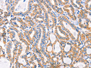 The image on the left is immunohistochemistry of paraffin-embedded Human thyroid cancer tissue using CSB-PA046001(F13A1 Antibody) at dilution 1/80, on the right is treated with synthetic peptide. (Original magnification: ×200)