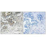 Immunohistochemistry analysis of paraffin-embedded human prostate carcinoma tissue using Claudin 7 (Ab-210) antibody.